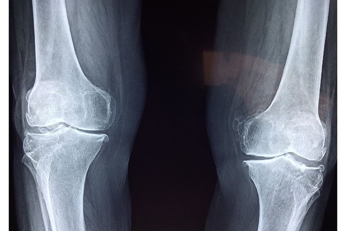 Image from the article by Healio Endocrinology: GLP-1 therapies linked to lower fracture risk
